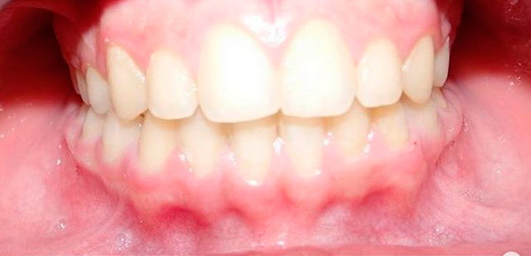 La ortodoncia mejora la funcionalidad y la estétia facial